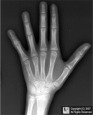 turner syndrome